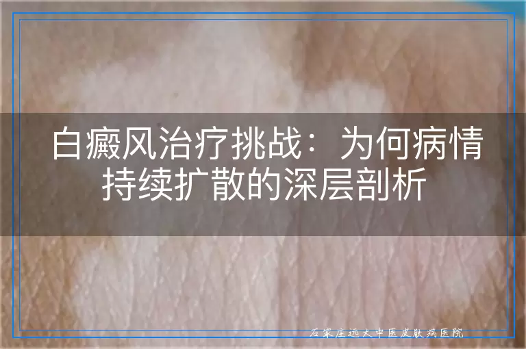 白癜风治疗挑战：为何病情持续扩散的深层剖析