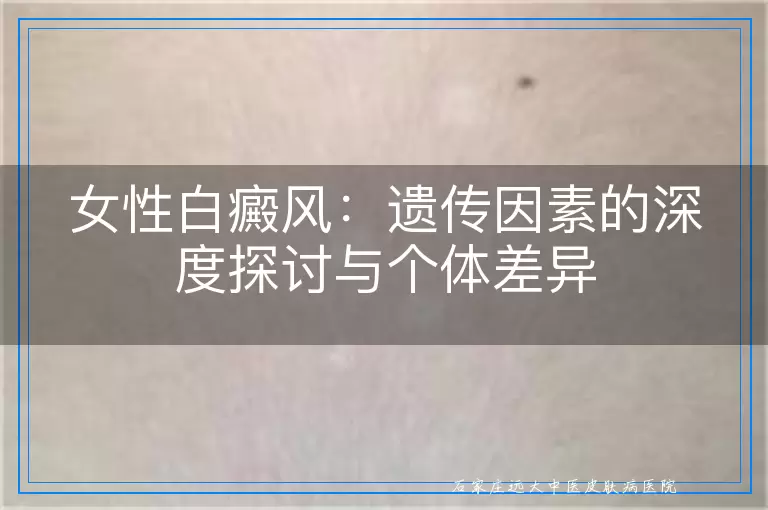 女性白癜风：遗传因素的深度探讨与个体差异