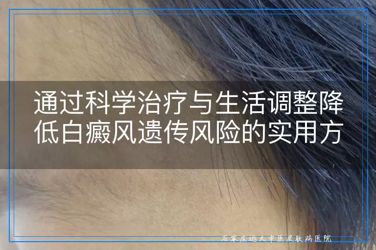 通过科学治疗与生活调整降低白癜风遗传风险的实用方法