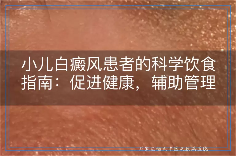 小儿白癜风患者的科学饮食指南：促进健康，辅助管理白斑