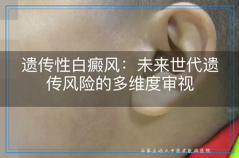 遗传性白癜风：未来世代遗传风险的多维度审视