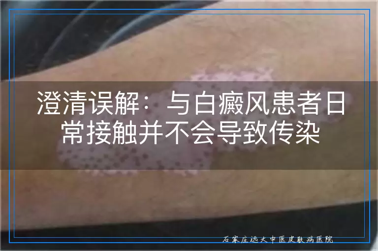澄清误解：与白癜风患者日常接触并不会导致传染