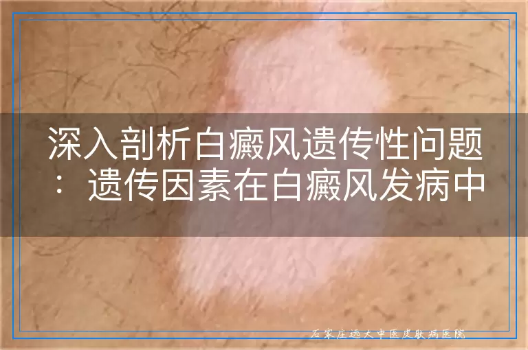 深入剖析白癜风遗传性问题：遗传因素在白癜风发病中的角色与影响