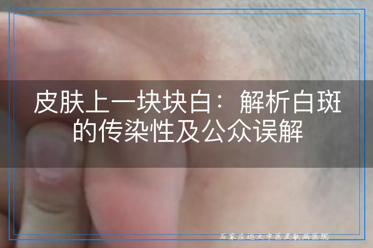 皮肤上一块块白：解析白斑的传染性及公众误解