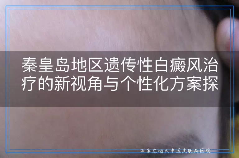 秦皇岛地区遗传性白癜风治疗的新视角与个性化方案探讨