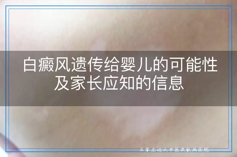 白癜风遗传给婴儿的可能性及家长应知的信息
