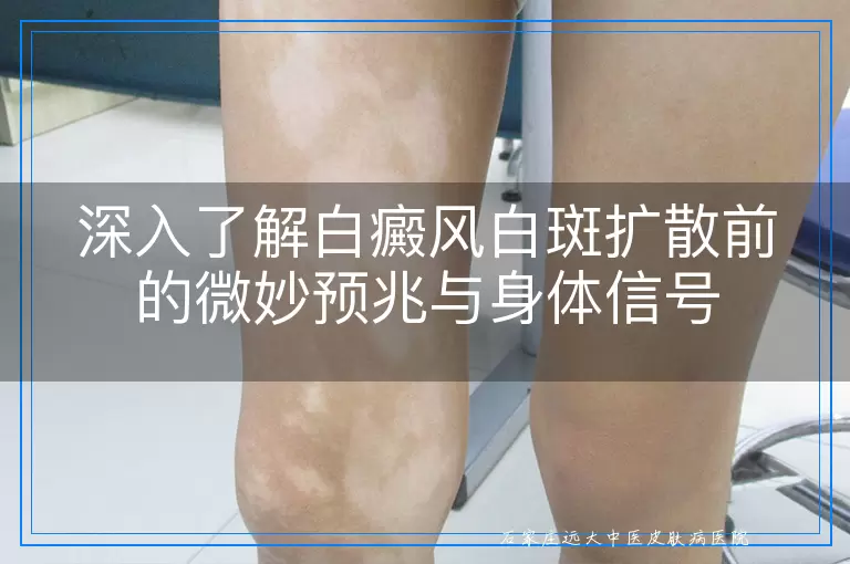 深入了解白癜风白斑扩散前的微妙预兆与身体信号