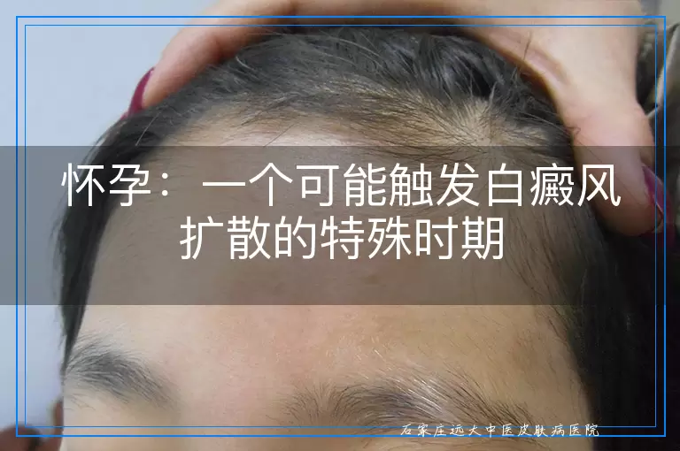 怀孕：一个可能触发白癜风扩散的特殊时期