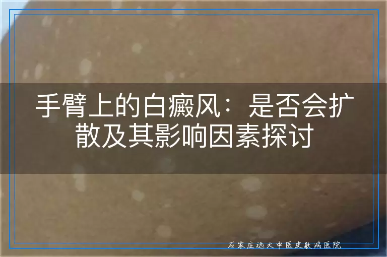 手臂上的白癜风：是否会扩散及其影响因素探讨