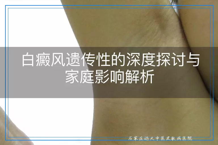 白癜风遗传性的深度探讨与家庭影响解析