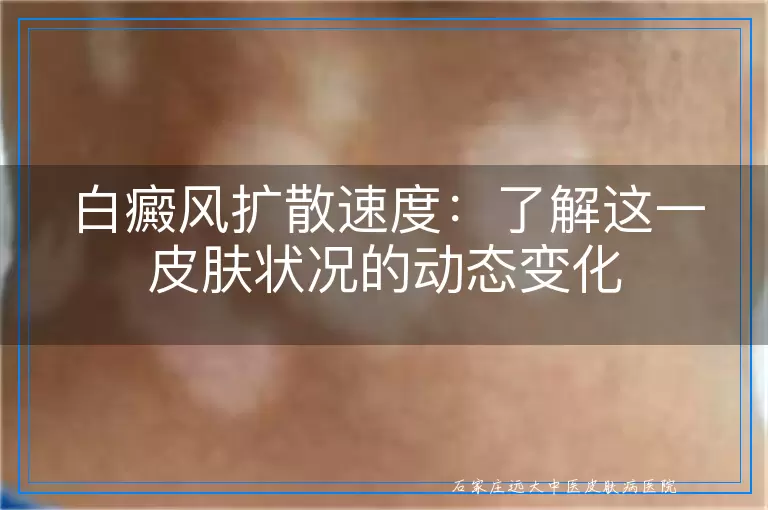 白癜风扩散速度：了解这一皮肤状况的动态变化