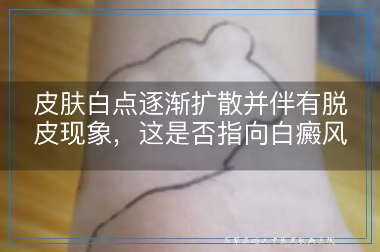 皮肤白点逐渐扩散并伴有脱皮现象，这是否指向白癜风的可能？