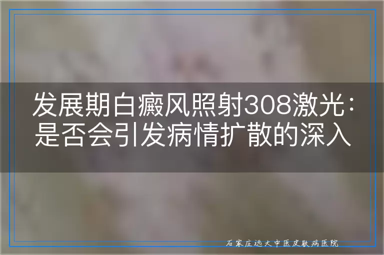发展期白癜风照射308激光：是否会引发病情扩散的深入探讨