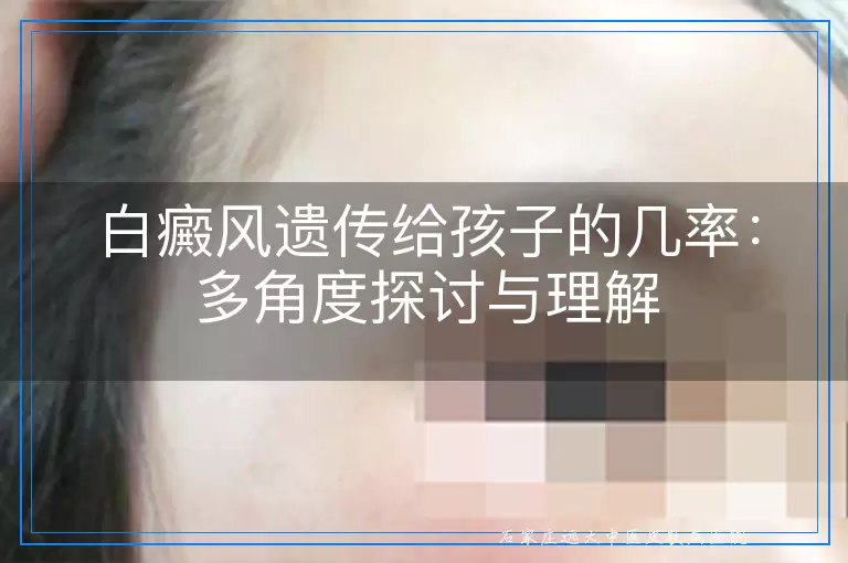 白癜风遗传给孩子的几率：多角度探讨与理解
