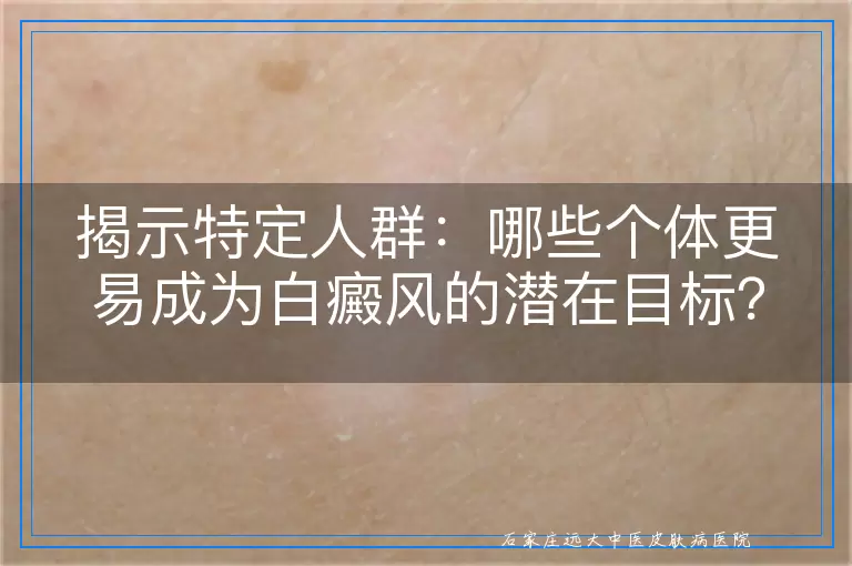 揭示特定人群：哪些个体更易成为白癜风的潜在目标？