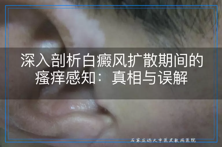 深入剖析白癜风扩散期间的瘙痒感知：真相与误解