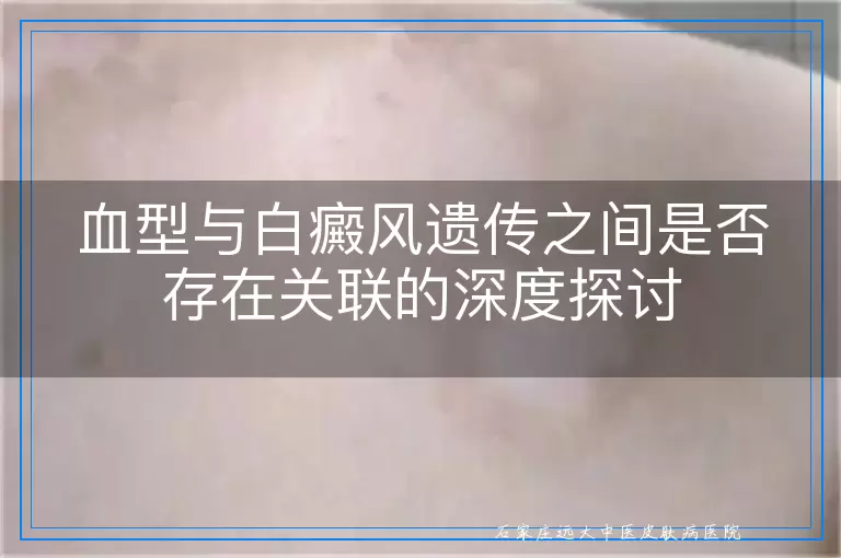 血型与白癜风遗传之间是否存在关联的深度探讨