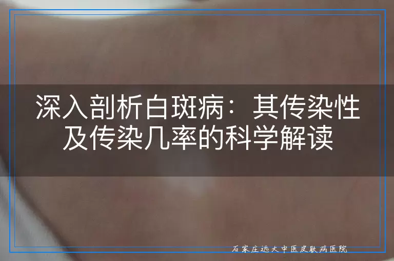 深入剖析白斑病：其传染性及传染几率的科学解读