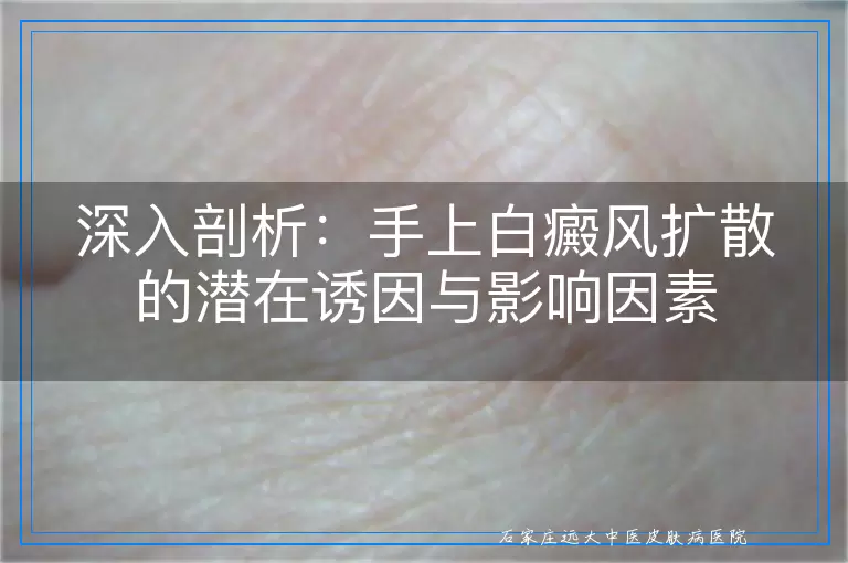 深入剖析：手上白癜风扩散的潜在诱因与影响因素