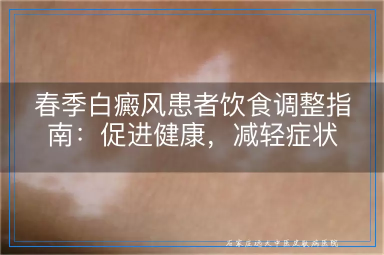 春季白癜风患者饮食调整指南：促进健康，减轻症状