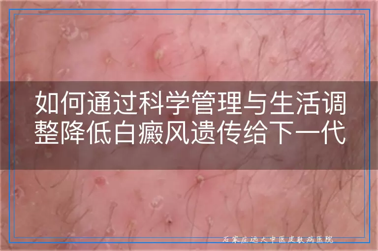 如何通过科学管理与生活调整降低白癜风遗传给下一代的机率