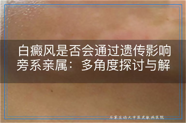 白癜风是否会通过遗传影响旁系亲属：多角度探讨与解析