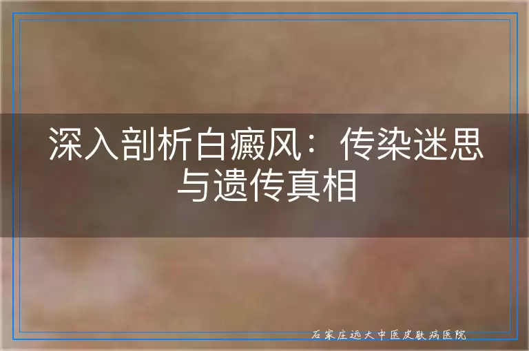 深入剖析白癜风：传染迷思与遗传真相