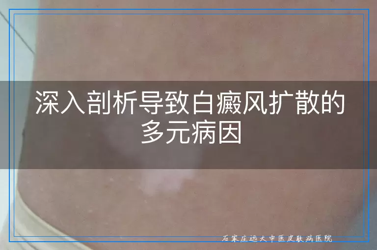 深入剖析导致白癜风扩散的多元病因