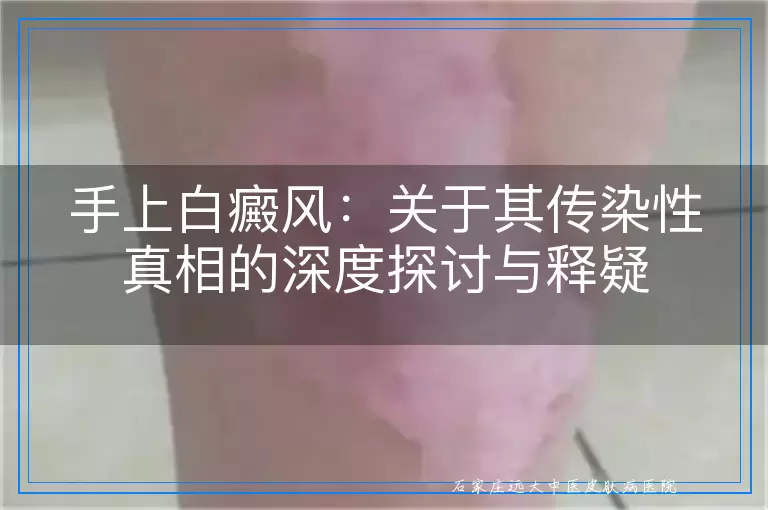 手上白癜风：关于其传染性真相的深度探讨与释疑