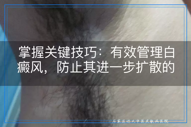 掌握关键技巧：有效管理白癜风，防止其进一步扩散的实用方法