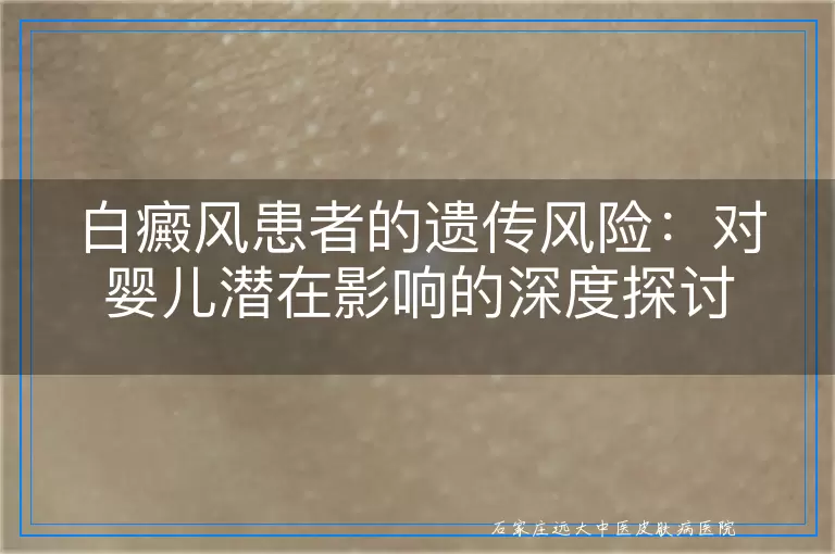 白癜风患者的遗传风险：对婴儿潜在影响的深度探讨