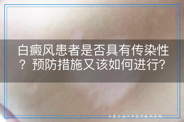 白癜风患者是否具有传染性？预防措施又该如何进行？