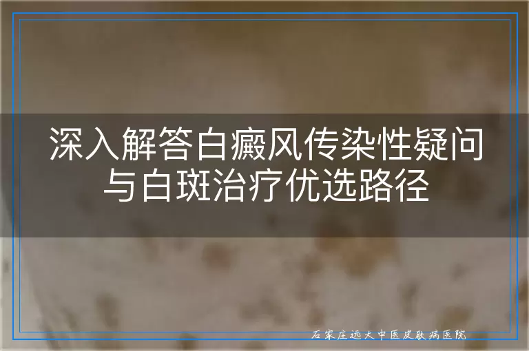 深入解答白癜风传染性疑问与白斑治疗优选路径