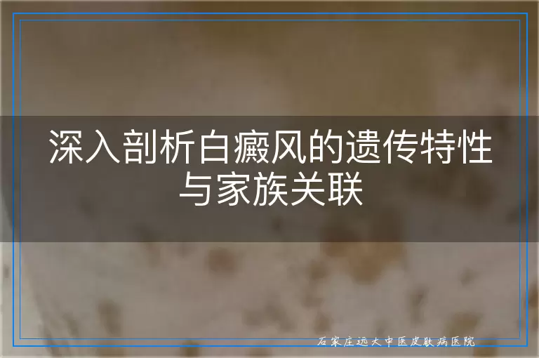 深入剖析白癜风的遗传特性与家族关联