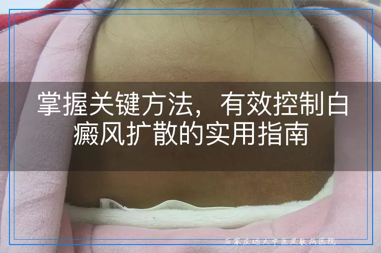 掌握关键方法，有效控制白癜风扩散的实用指南