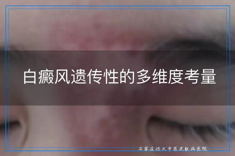 白癜风遗传性的多维度考量