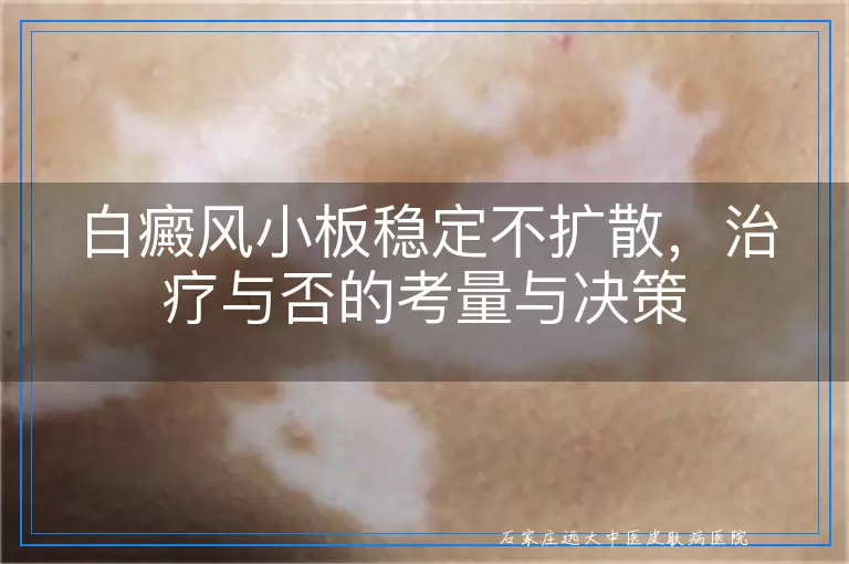 白癜风小板稳定不扩散，治疗与否的考量与决策