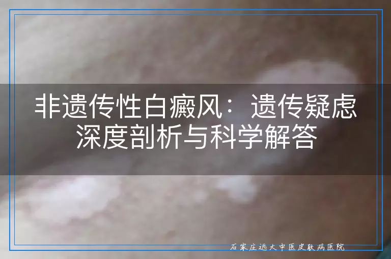 非遗传性白癜风：遗传疑虑深度剖析与科学解答