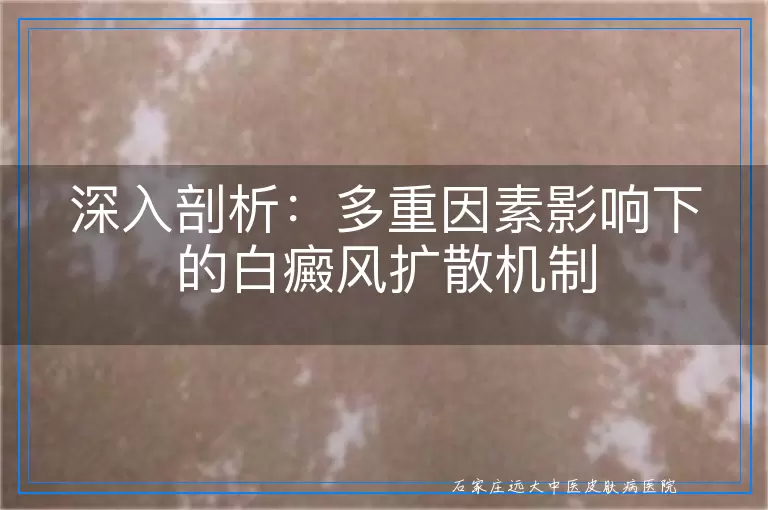 深入剖析：多重因素影响下的白癜风扩散机制