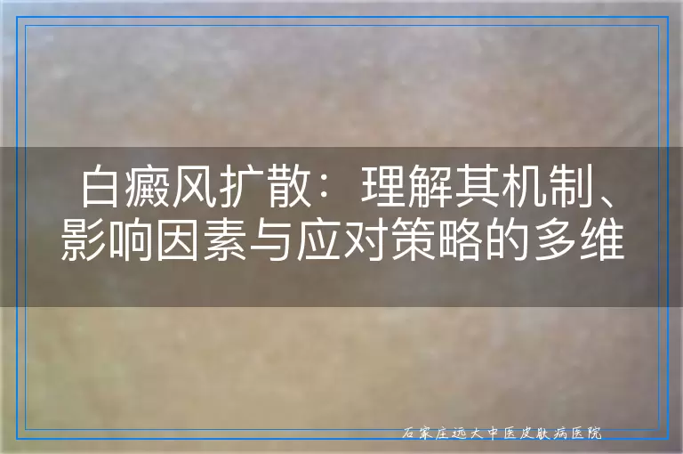 白癜风扩散：理解其机制、影响因素与应对策略的多维度视角