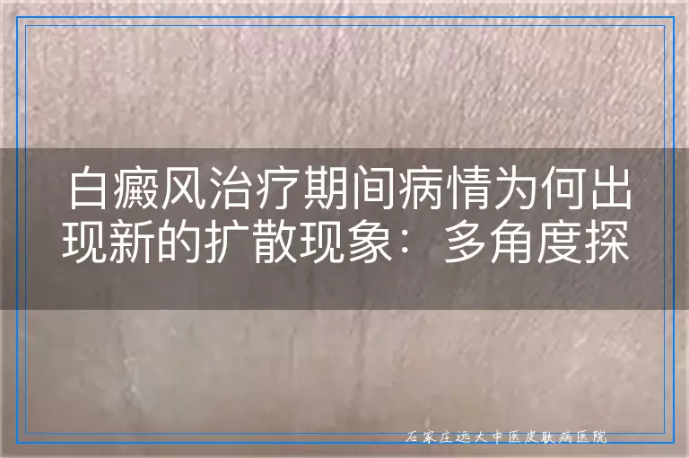 白癜风治疗期间病情为何出现新的扩散现象：多角度探讨与管理