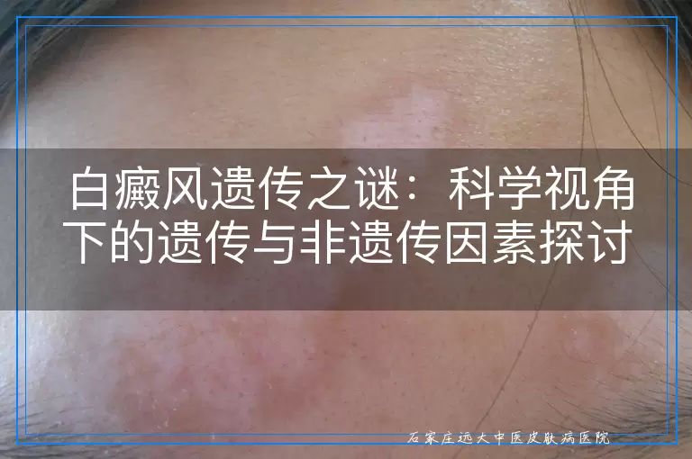 白癜风患者饮食调整指南：关注营养，促进健康，避免误区