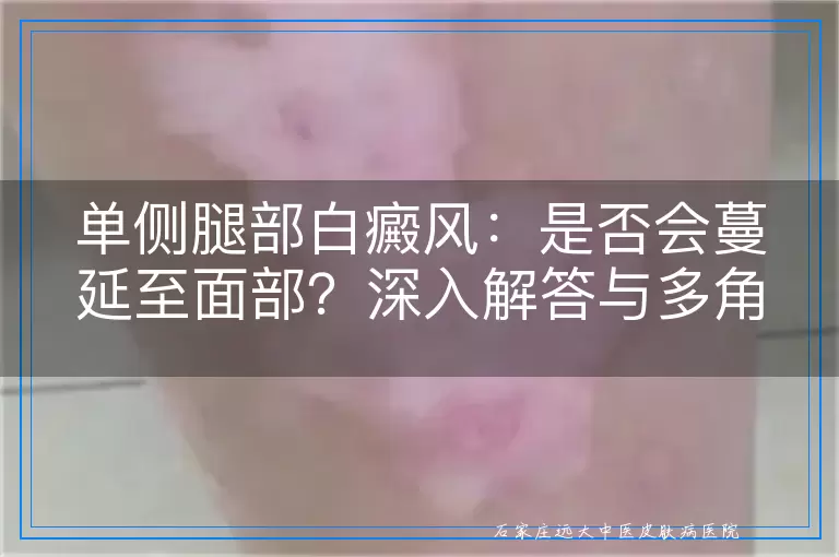 单侧腿部白癜风：是否会蔓延至面部？深入解答与多角度探讨