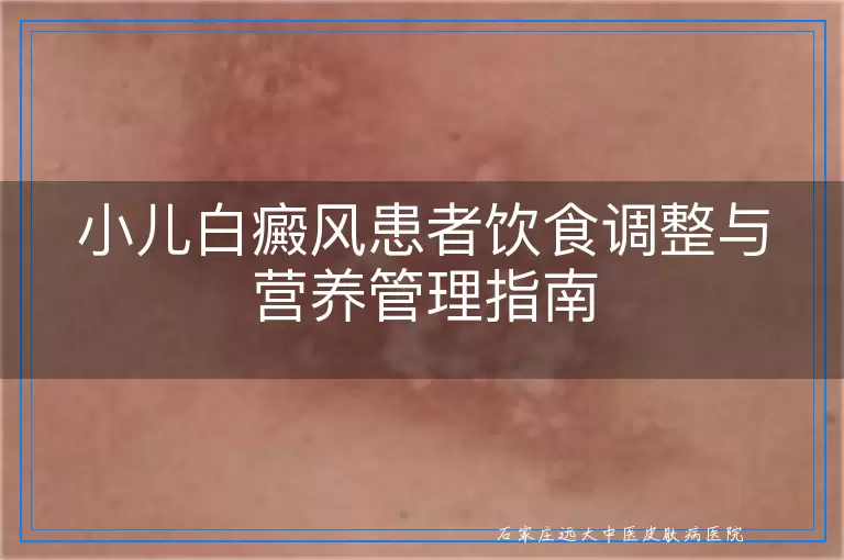 小儿白癜风患者饮食调整与营养管理指南