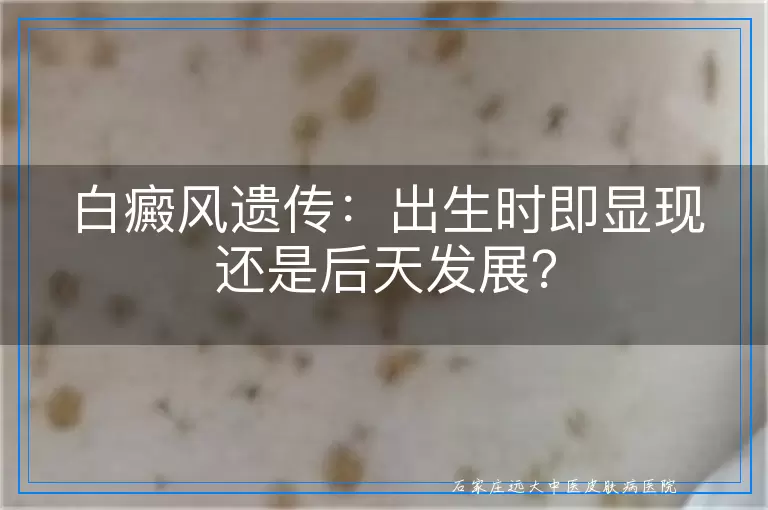 白癜风遗传：出生时即显现还是后天发展？