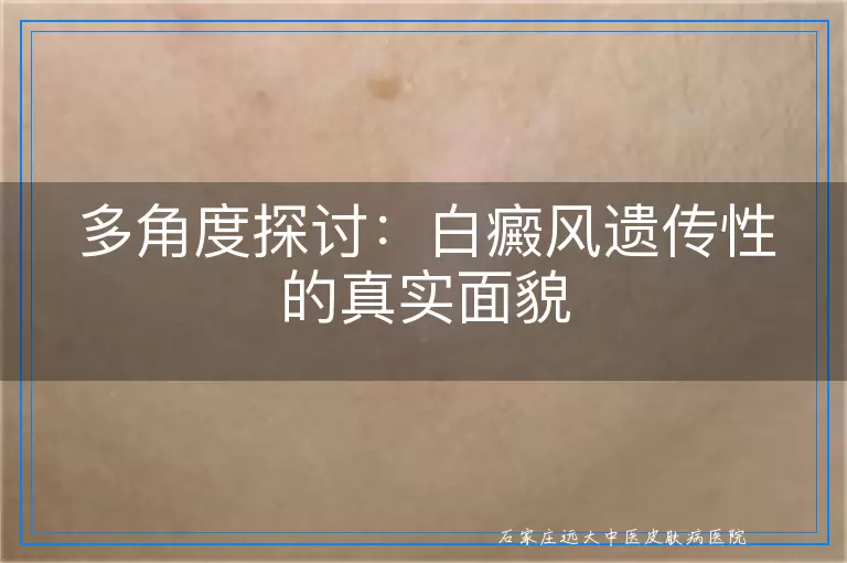 多角度探讨：白癜风遗传性的真实面貌