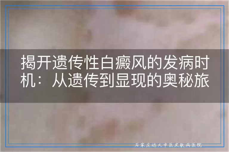揭开遗传性白癜风的发病时机：从遗传到显现的奥秘旅程
