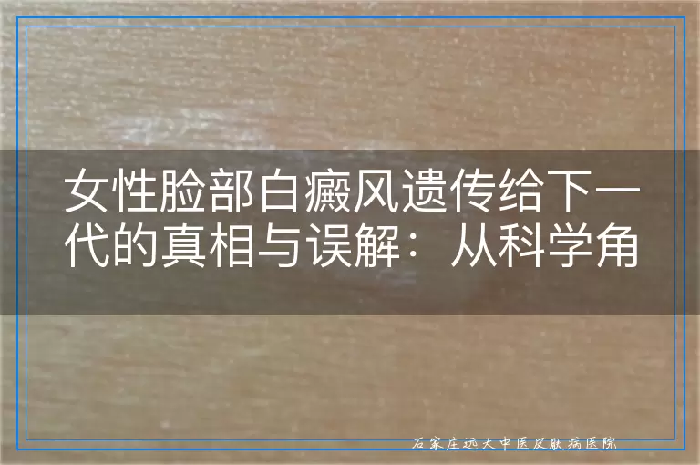 女性脸部白癜风遗传给下一代的真相与误解：从科学角度深入剖析