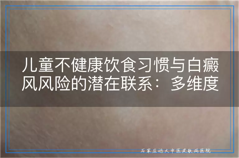 儿童不健康饮食习惯与白癜风风险的潜在联系：多维度视角探讨