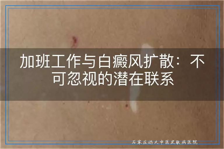 加班工作与白癜风扩散：不可忽视的潜在联系